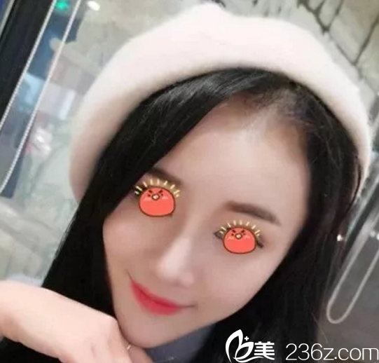 我在桂林華美做鼻綜合手術(shù)后1個月 我在桂林華美做鼻綜合手術(shù)后1個月