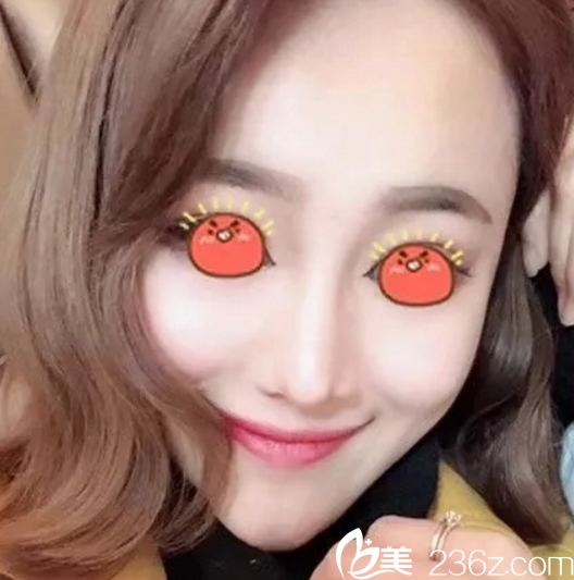 看一下我找桂林華美做了鼻綜合手術(shù)3個月的效果你就知道院長技術(shù)怎么樣