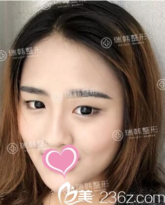 做雙眼皮整形術(shù)前照 做雙眼皮整形術(shù)前照