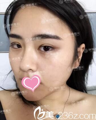 瑞韓蘿莉大眼術(shù)后第3天 瑞韓蘿莉大眼術(shù)后第3天