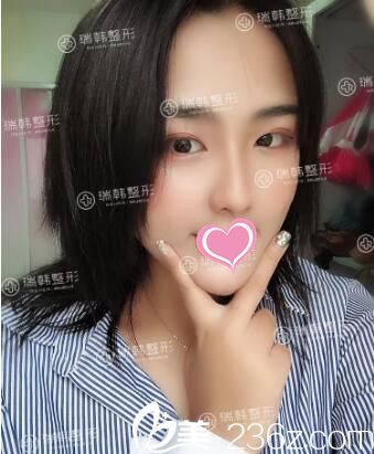 在瑞韓做雙眼皮術(shù)后20天效果 在瑞韓做雙眼皮術(shù)后20天效果