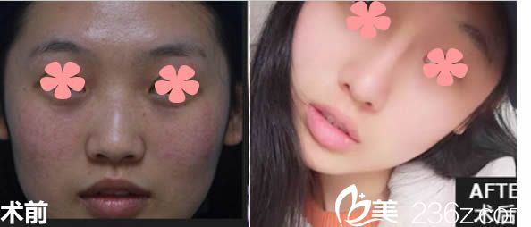 賈洪仁院長(zhǎng)鼻綜合隆鼻前后對(duì)比效果