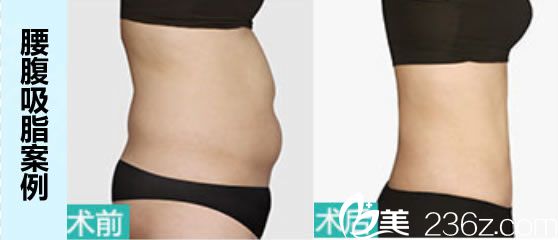 泉州歐菲韓飛腰腹吸脂案例及前后對(duì)比效果 泉州歐菲韓飛腰腹吸脂案例及前后對(duì)比效果