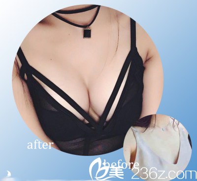 假體隆胸術(shù)前術(shù)后對比案例