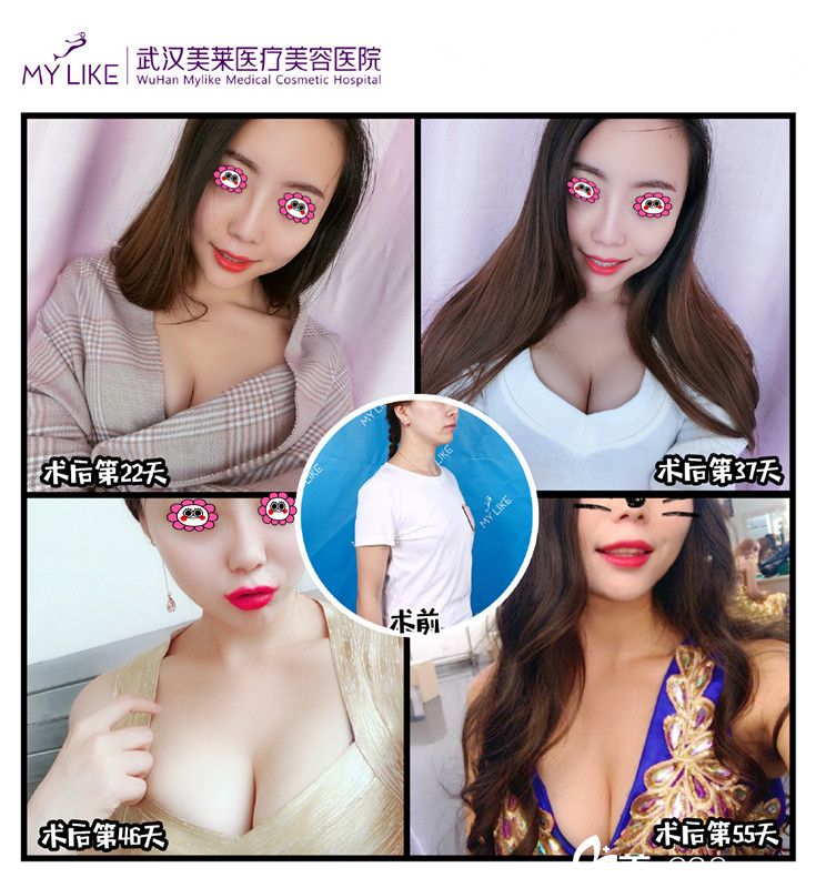 武漢美萊王俊河豐胸前后變化圖