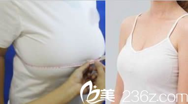 韓國(guó)一美知整形巨乳縮小美化術(shù)案例效果對(duì)比圖 韓國(guó)一美知整形巨乳縮小美化術(shù)案例效果對(duì)比圖
