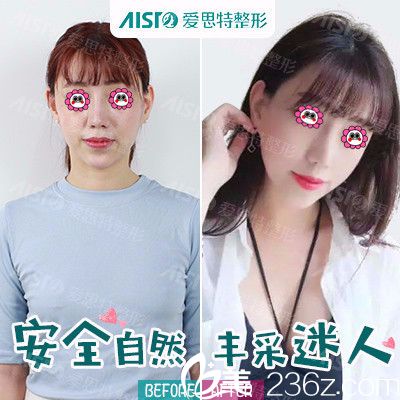 在找孫院長做豐胸效果圖 在找孫院長做豐胸效果圖