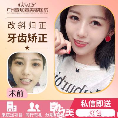 廣州壹加壹隱形牙齒矯正實(shí)例
