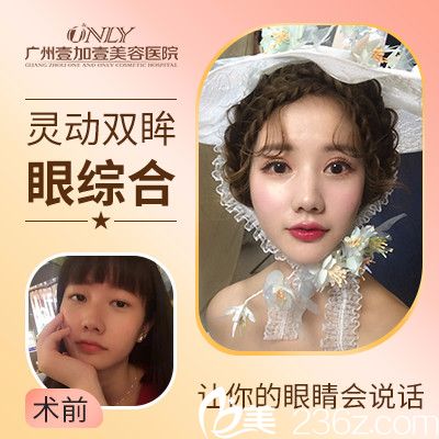 廣州壹加壹雙眼皮實(shí)例