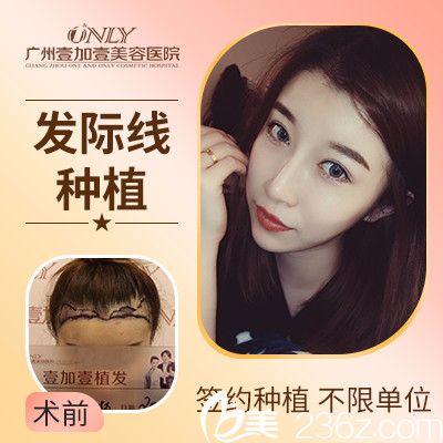 廣州壹加壹發(fā)際線種植實(shí)例