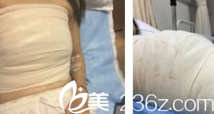 胸部修復(fù)術(shù)前照片