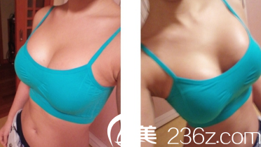 修復(fù)完成之后胸部的狀態(tài)