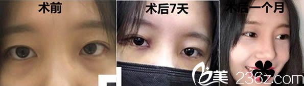 石獅栢麗內(nèi)切祛眼袋案例及恢復(fù)過程圖