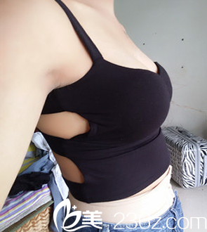 我找太原歐美蓮張世民做自體脂肪隆胸術(shù)后第3天照片 我找太原歐美蓮張世民做自體脂肪隆胸術(shù)后第3天照片