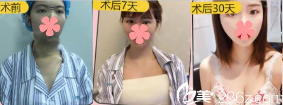 石獅栢麗曼托假體隆胸前后對比案例