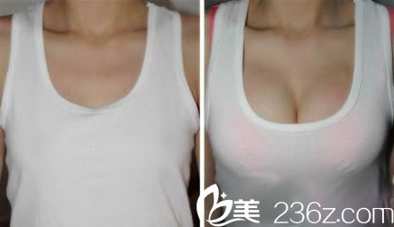 韓國瑞姿整形崔載英院長假體隆胸效果對比圖 韓國瑞姿整形崔載英院長假體隆胸效果對比圖