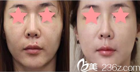 瑞姿整形醫(yī)院面部提升案例對比圖 瑞姿整形醫(yī)院面部提升案例對比圖