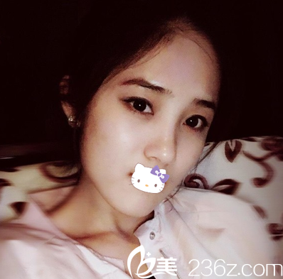 快來幫我看看綿陽朗睿整形美容醫(yī)院劉鋒給我做的假體+耳軟骨綜合隆鼻怎么樣？