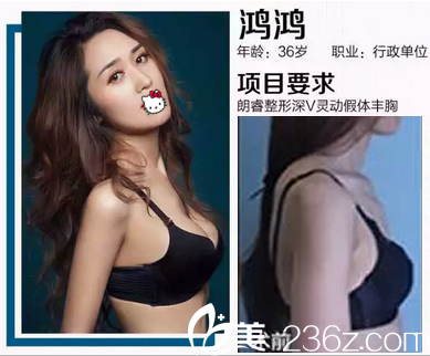 假體豐胸前后對比 假體豐胸前后對比