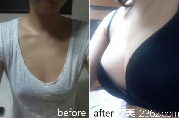 曹新成醫(yī)生豐胸真人案例