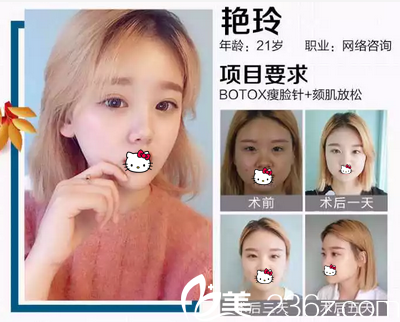 瘦臉術(shù)后效果 瘦臉術(shù)后效果