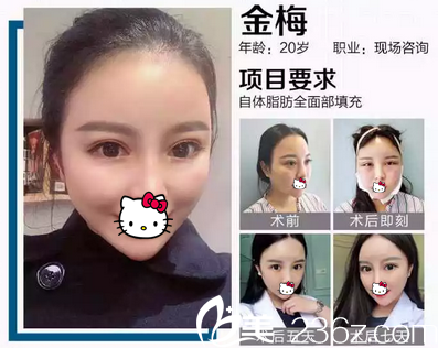 自體脂肪全面部填充恢復(fù)過程 自體脂肪全面部填充恢復(fù)過程