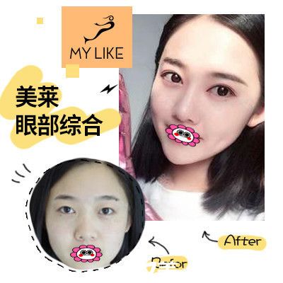 整形醫(yī)院雙眼皮對比案例