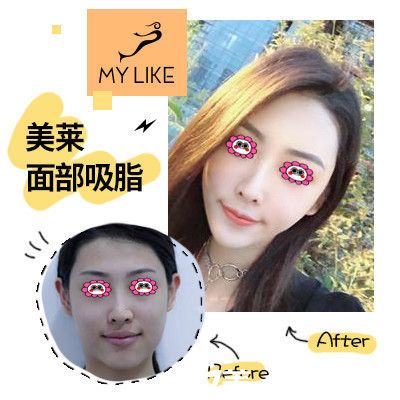 我在找院長做面部吸脂后的變化圖