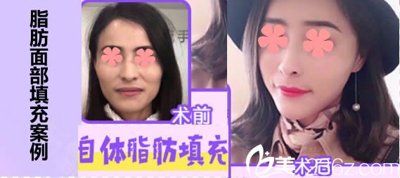 漳州美博士是正規(guī)醫(yī)院嗎？近期整形價(jià)格表公布/全臉自體脂肪填充19800元