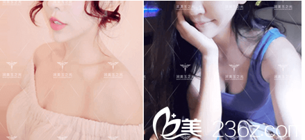 北京潤美玉之光脂肪豐胸 北京潤美玉之光脂肪豐胸