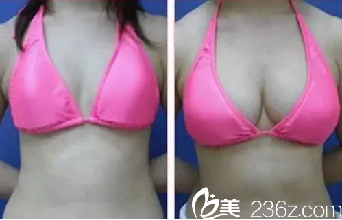 曹家整形隆胸前后對(duì)比 曹家整形隆胸前后對(duì)比