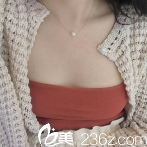 高超醫(yī)生給我做假體隆胸第8天效果 高超醫(yī)生給我做假體隆胸第8天效果