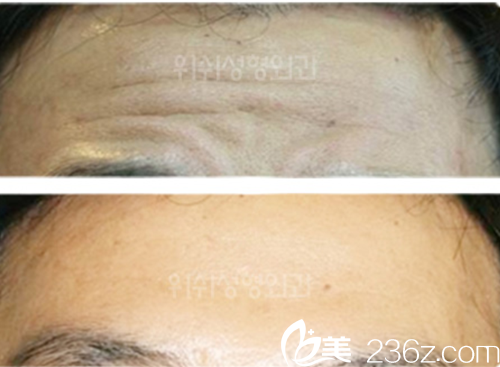 韓國(guó)WESHE整形外科醫(yī)院除皺