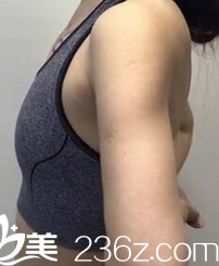 在北京葉子做脂肪豐胸前樣子 在北京葉子做脂肪豐胸前樣子