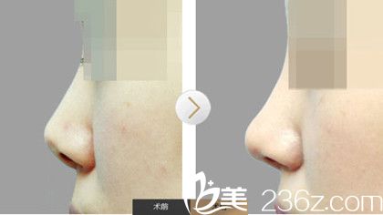 南京康美慶雙旦迎新年提前推送2019優(yōu)惠價格表，自體脂肪面部填充2次+耳軟骨墊鼻尖僅需9999元