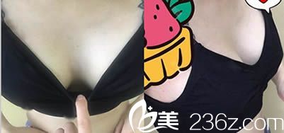 前年在整形讓陳茂年院長(zhǎng)做的眼綜合很滿意 今年讓給做假體隆胸