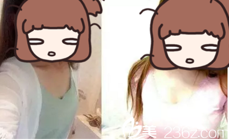 劉宏偉醫(yī)生隆胸效果圖 劉宏偉醫(yī)生隆胸效果圖