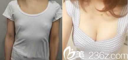 曲靖吳氏嘉美整形曼托假體隆胸效果對(duì)比圖