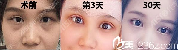 比華利林平全切雙眼皮案例及一個(gè)月恢復(fù)效果