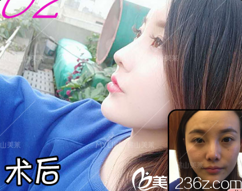 佛山美萊王燕隆鼻案例 佛山美萊王燕隆鼻案例