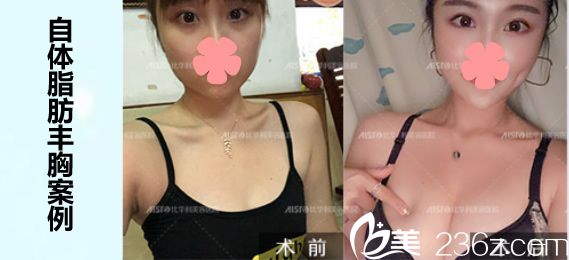 劉耀美自體脂肪豐胸案例