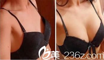 北京美萊整形才杰假體隆胸案例前后對比圖
