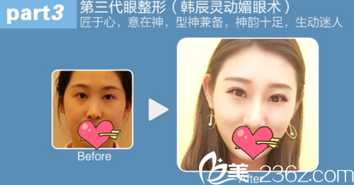 南京韓辰周創(chuàng)業(yè)做的雙眼皮案例效果圖