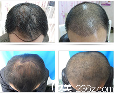 南京韓辰陳安邦院長頭發(fā)種植案例