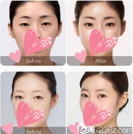 2018圣誕+2019元旦一起相約無錫施爾美 無痕雙眼皮水動力吸脂回饋價都只要880元