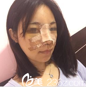 在南寧韓成做鼻綜合手術(shù)后第2天