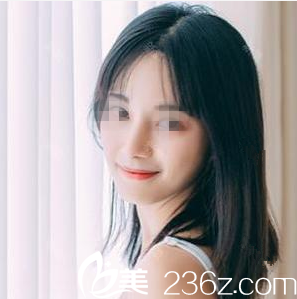 在南寧韓成做鼻綜合手術(shù)后1個月