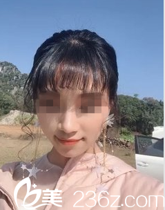 朋友推薦我來南寧韓成做膨體+肋軟骨隆鼻術(shù)后2個(gè)月鼻子就像天生的一樣自然