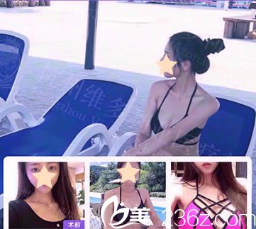 杭州維多利亞假體隆胸效果對比圖 杭州維多利亞假體隆胸效果對比圖