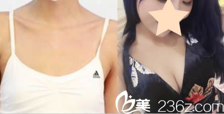 東莞水立方李志剛主任假體隆胸案例效果圖